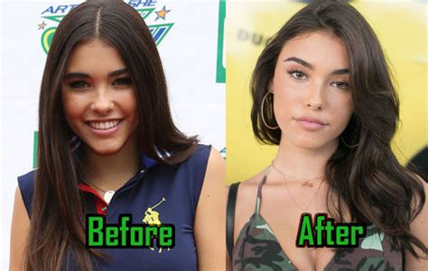 Madison Beer plastic surgery: Breast Implants,Before。